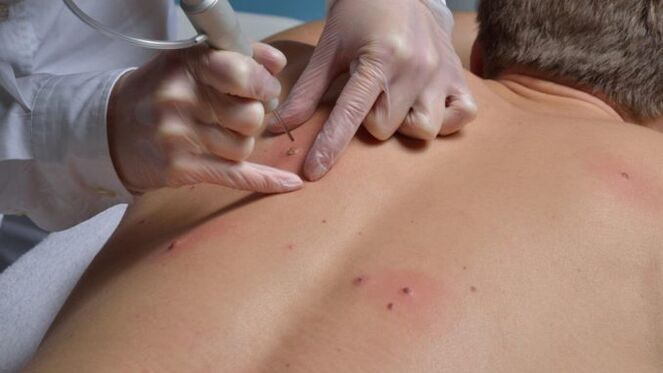Eliminate papilloma of the back with a laser