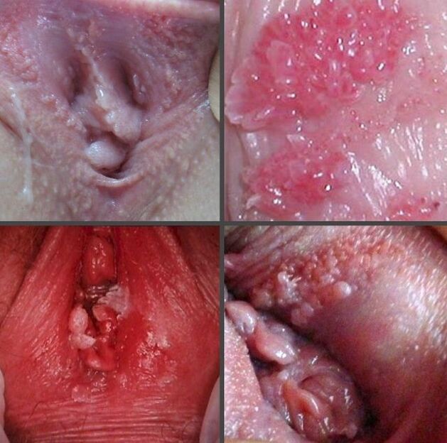 Papillomas in the vagina were closed