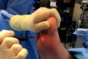 surgical method for removing warts