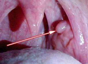 Papilloma on the larynx
