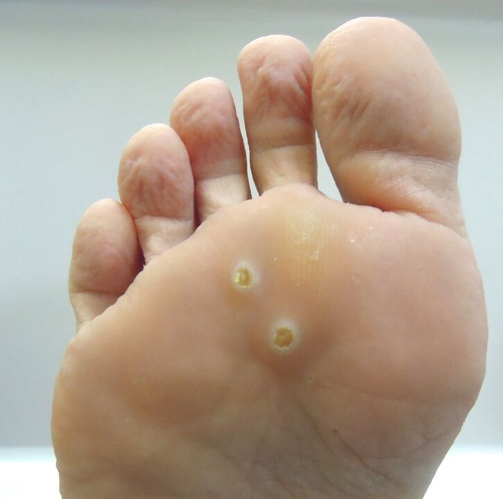 how to get rid of a wart on the foot