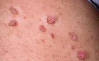 the causes of the appearance of papillomas on the body